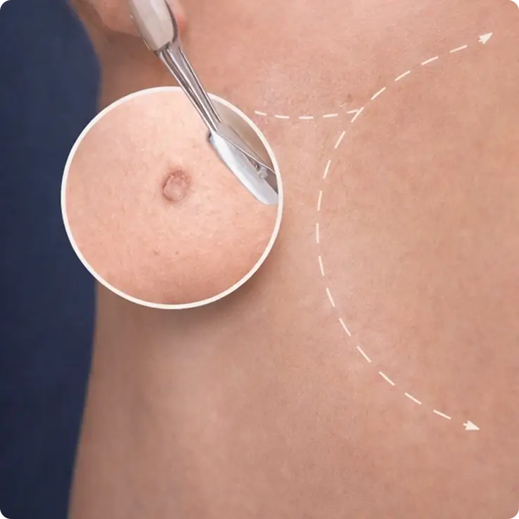 Skin Lesion